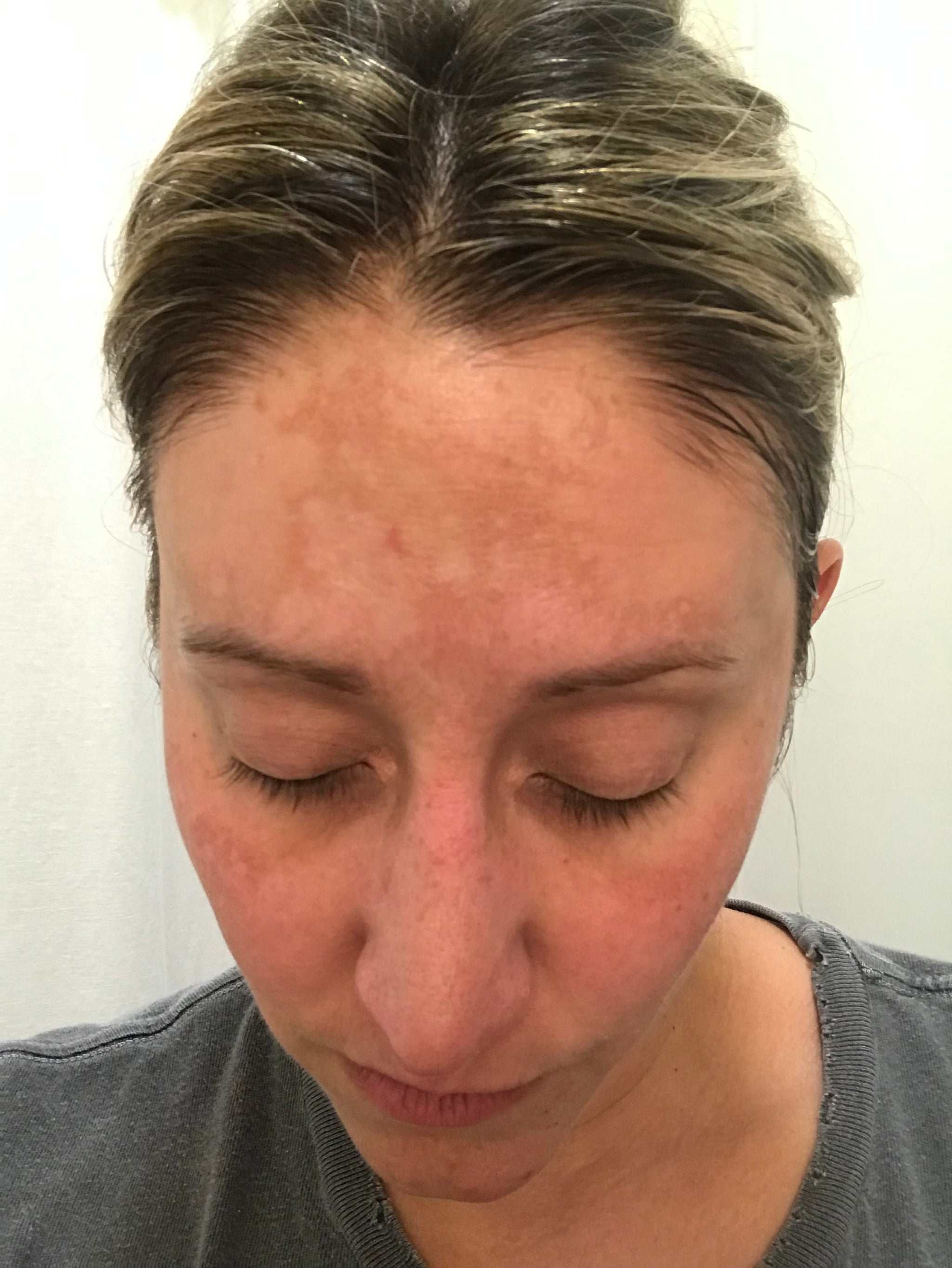 Healing Melasma AKA